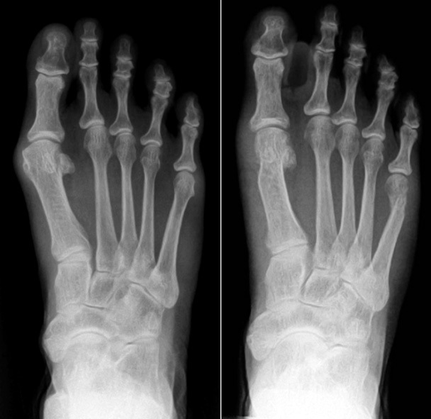 Ossio fiber before and after bunion surgery x-ray