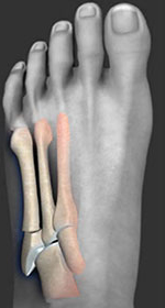 Jones Fracture, Fifth metatarsal fracture, University foot and ankle institute