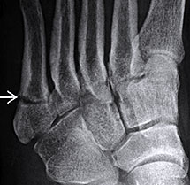 Jones Fracture, University Foot and Ankle Institute