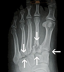 Lisfranc Fracture, Midfoot fracture, University Foot and Ankle Institute